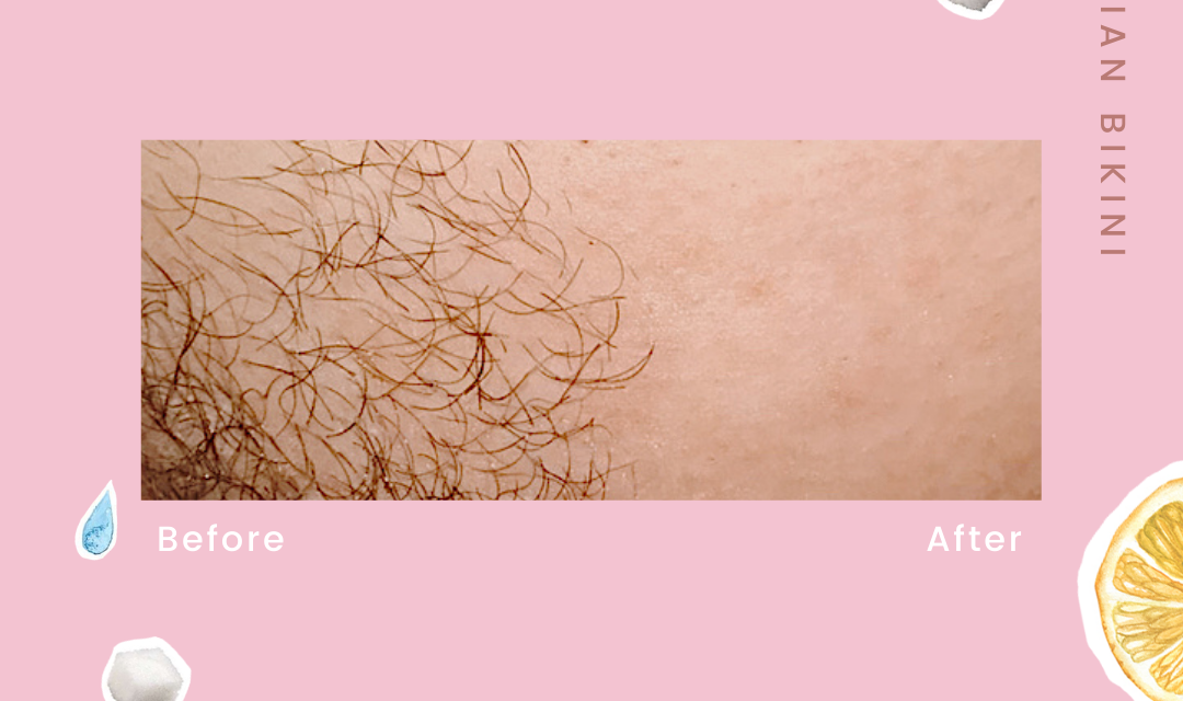 Does sugaring hurt less than waxing?